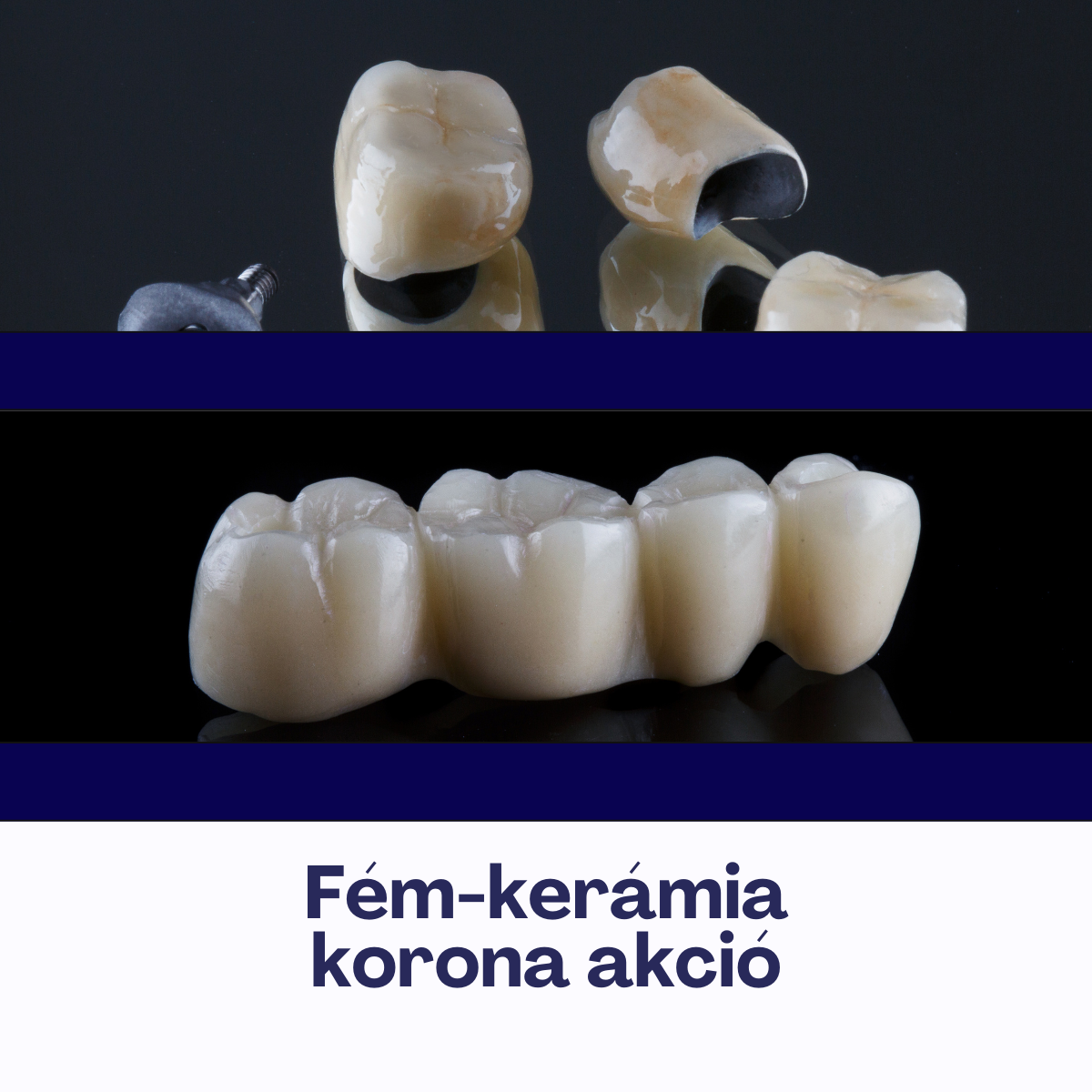 Fém-kerámia korona akció