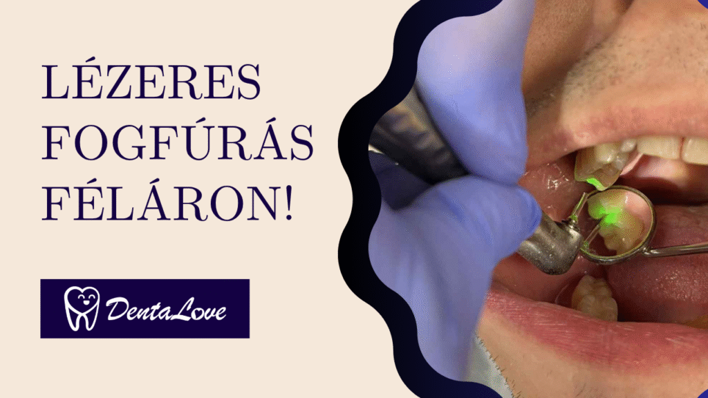 Lézeres fogfúrás féláron