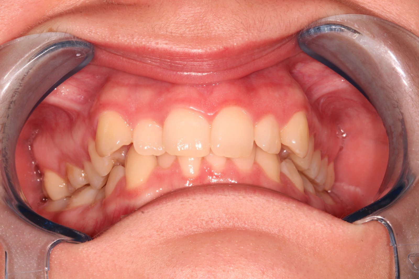 Fogszabályzó előtt