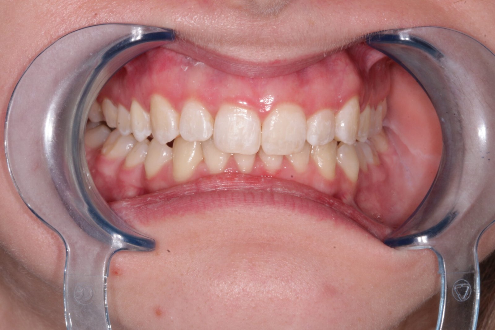 Fogszabályzó után